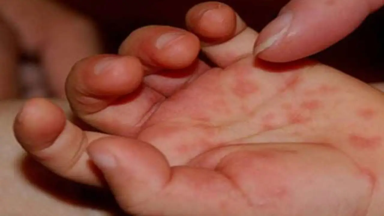 Rickettsiosis, la enfermedad que se confunde con el dengue, genera preocupación en Honduras.